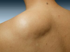 Cirurgia de retirada de Lipoma